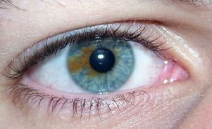 sectoral heterochromia.jpg